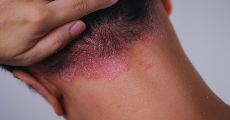 Psoriáza ve vlasech: Příznaky, léčba a účinná přírodní péče